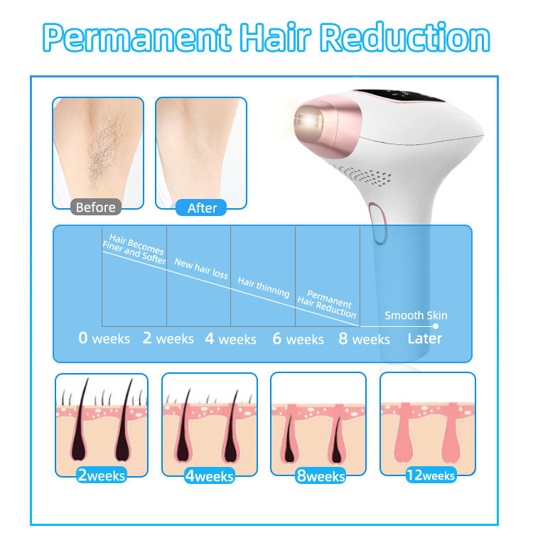 IPL-Laser-Haarentfernungsgerät mit Eiskühlung